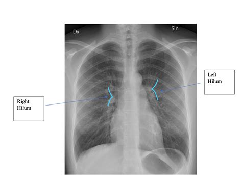 Imaging of Hila and Pulmonary Vessels 